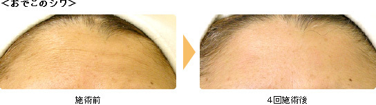 hydrafacial14.jpg