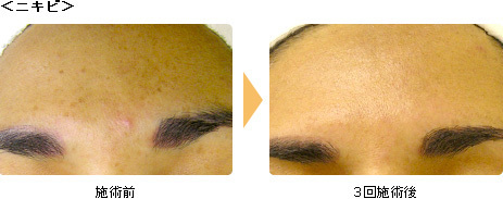 hydrafacial13.jpg