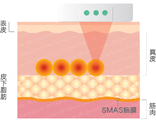 ウルセラ3mm.jpg