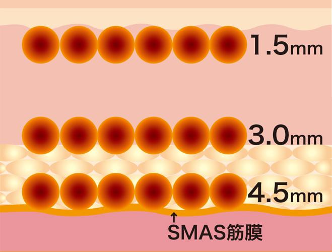 ウルセラ10／クロスクリニック銀座.jpg