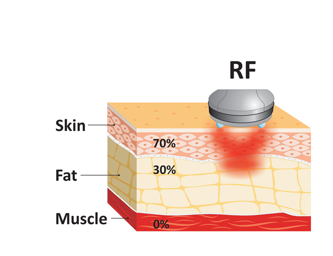 Fig2 B_Manipolo RF sul tessuto.jpg