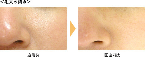 hydrafacial12.jpg