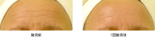 hydrafacial15.jpg