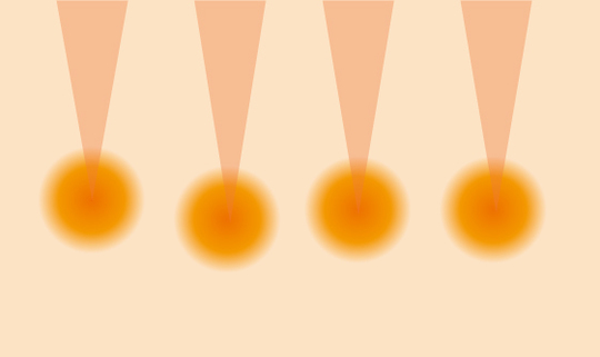 ウルセラ3/クロスクリニック銀座.jpg