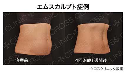 エムスカルプト(腹部)症例1|クロスクリニック銀座s.jpg